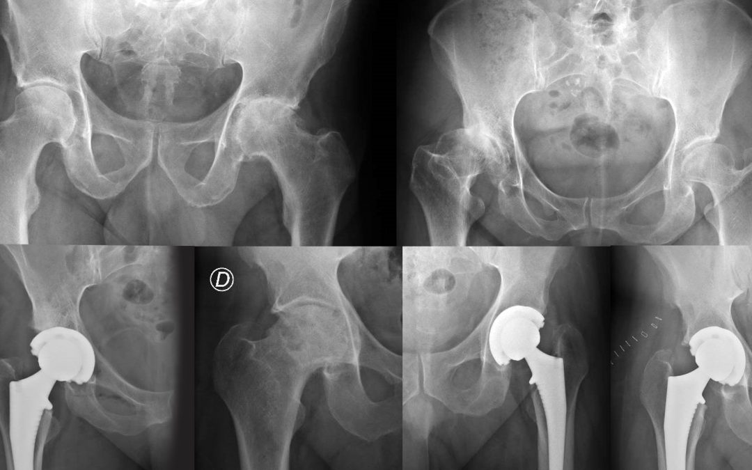 Recomendaciones tras cirugía de prótesis de cadera